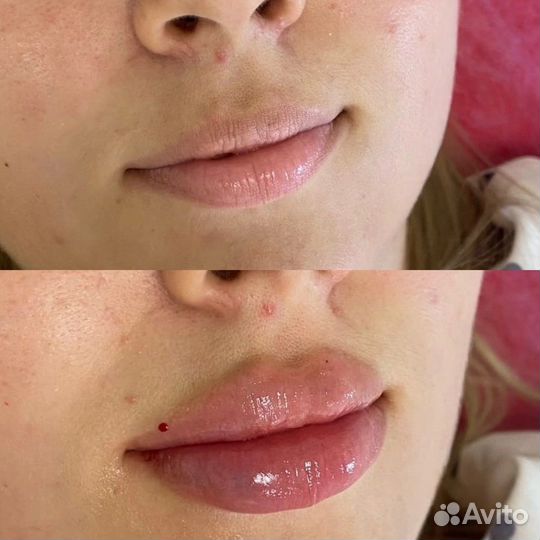 Увеличение губ