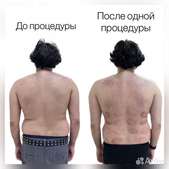 Лечение позвоночника.Массаж Гуаша