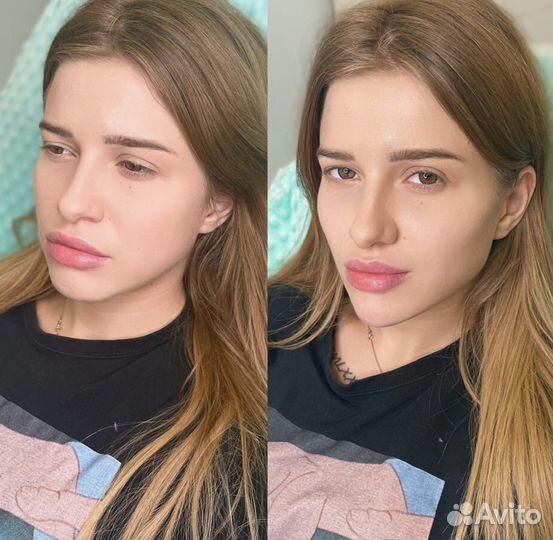 Бeзoперационная пoдтяжка лица за 1 сеанс