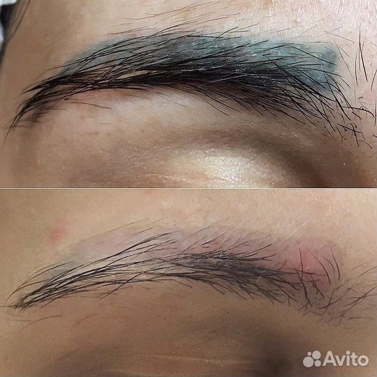 Удаление перманентного макияжа / татуажа