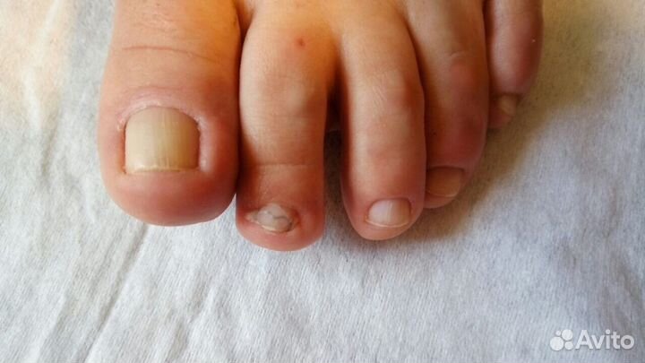 Медицинский педикюр, подолог, выезд на дом