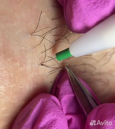 Электроэпиляция. Обучение в рассрочку