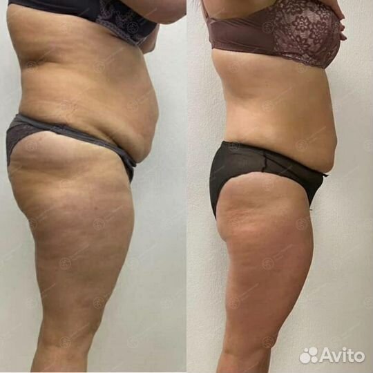 Безоперационная липосакция Криолиполиз