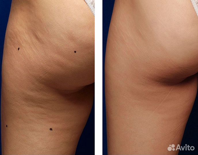 Липолитики для похудения по телу