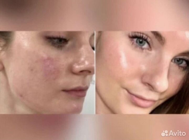 Карбоновый пилинг