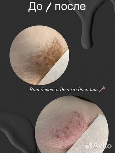 Шугаринг,Восковая эпиляция
