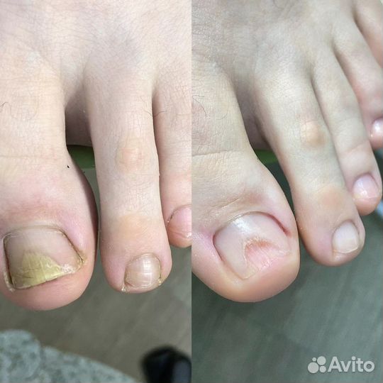 Подолог, смарт педикюр, маникюр
