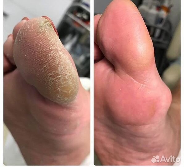 Карбамидный педикюр