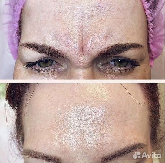 Косметолог. Челюстно-лицевой хирург. Ботокс