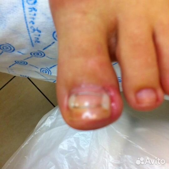 Медицинский педикюр, подолог, выезд на дом