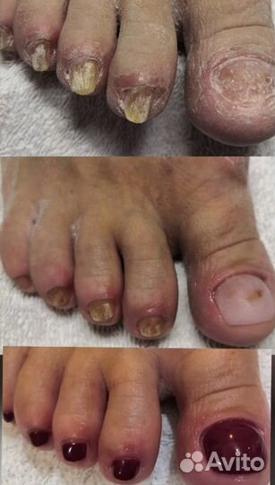 Медицинский педикюр, подолог,выезд на дом