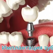 Имплантация зубов. Корейские импланты Osstem, Омск