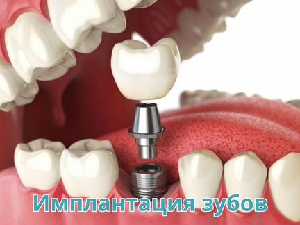 Имплантация зубов. Корейские импланты Osstem