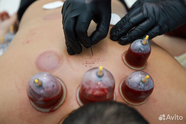 Хиджама бесплатное обучение с нуля