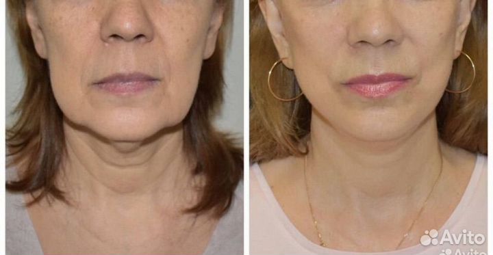 Биоревитализация,Пилинг,коллаген чистка,липолитики
