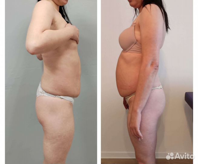 LPG массаж,ручной массаж,прессотерапия мио.ия