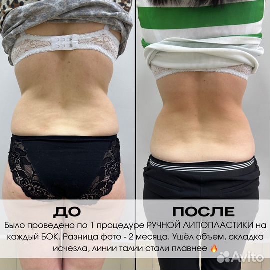 Массаж LPG / Vela Shape