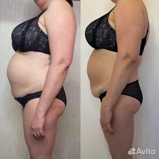 Аппаратный массаж R-Sleek Балтийская Жемчужина