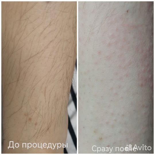 Электроэпиляция