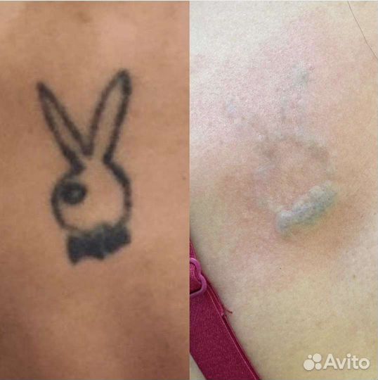 Лазерное удаление тату