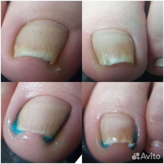 Титановая нить, Коррекционный педикюр