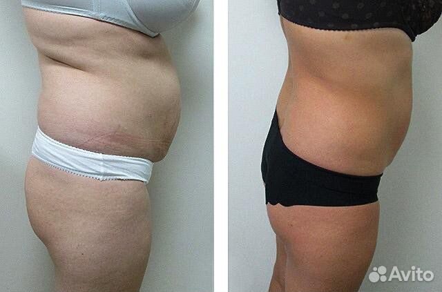 Аппаратный массаж LPG Курсы похудения