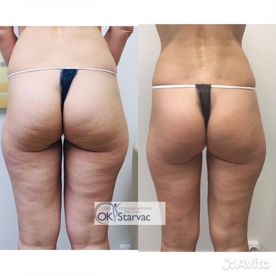 Массаж Старвак и аппаратная коррекциял тела
