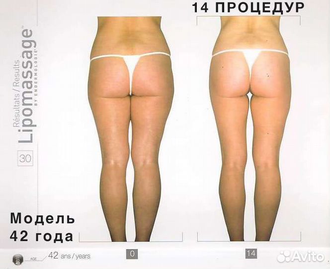 Аренда LPG аппаратов для массажа. LPG Keymodule