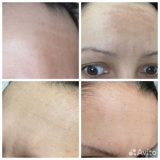 Крем от старой пигментации