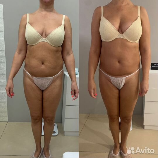 Vela Shape/Коррекция фигуры/rfлифтинг/узкавитация