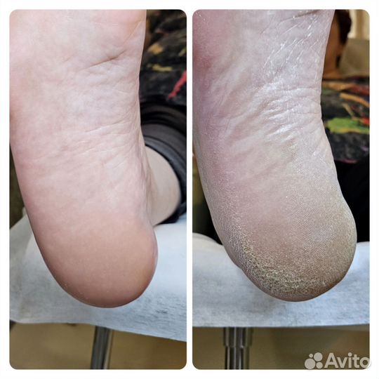 Специалист - Подолог, SMART pedicure