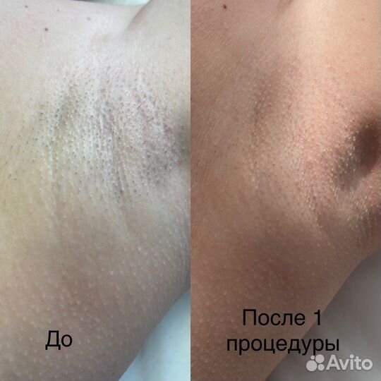 Лазерная эпиляция