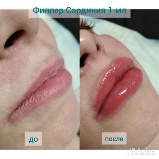 Красивые губы, увлажнение губ, Биоревитализация