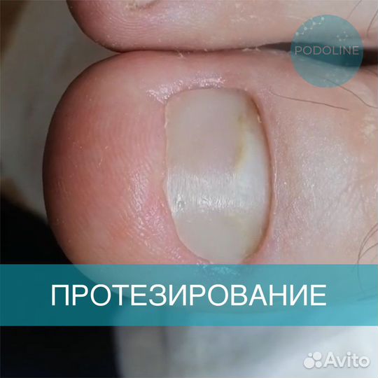 Подолог, вросший ноготь, грибок, отслоение