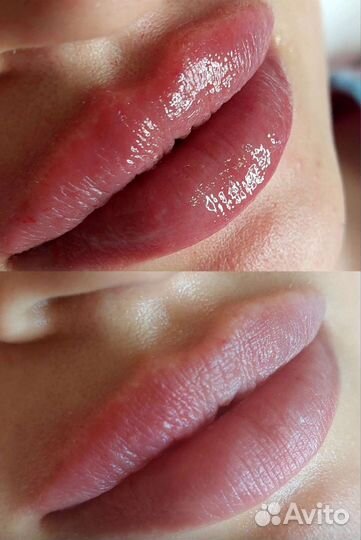 Увеличение губ