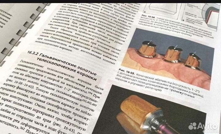 Протезирование с опорой на имплантаты