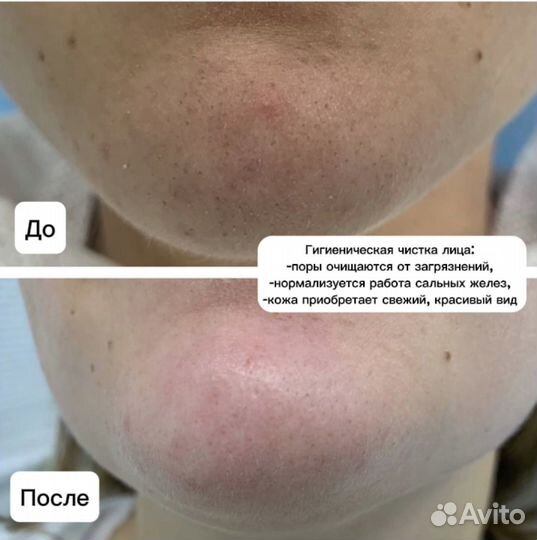 Косметолог Чистка лица Пилинг