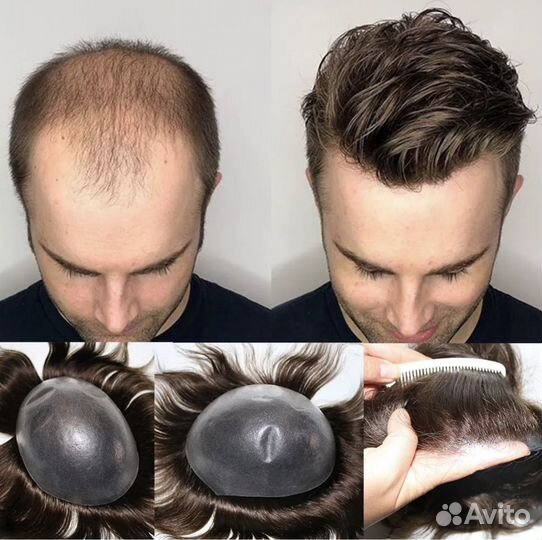 Система замещения волос для мужчин