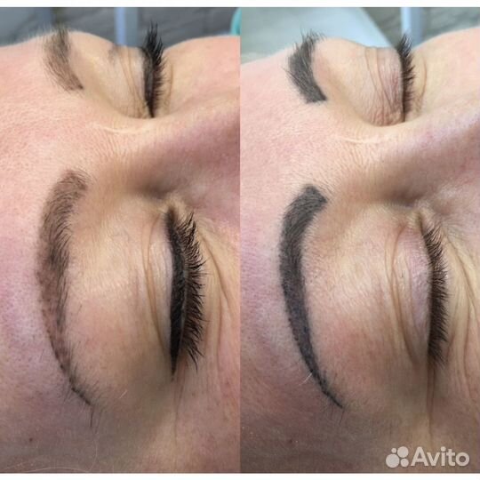 Удаление тату, татуажа бровей губ глаз