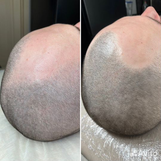 Трихопигментация для мужчин и женщин