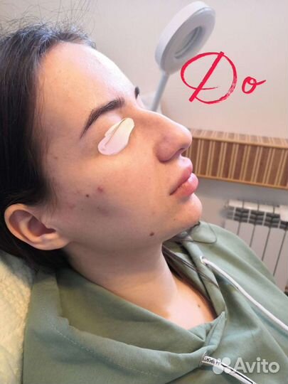 Коррекция формы носа