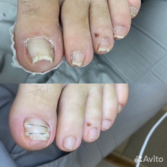 Медицинский педикюр подолог титановая нить