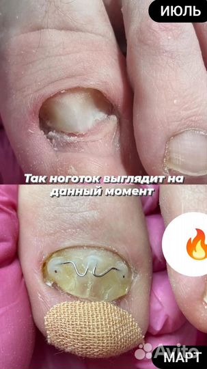 Лечебный педикюр подолог