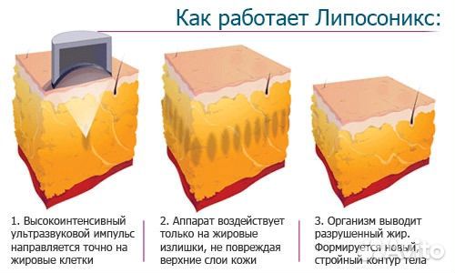 Безоперационная липосакция, липосоникс, жиротоп