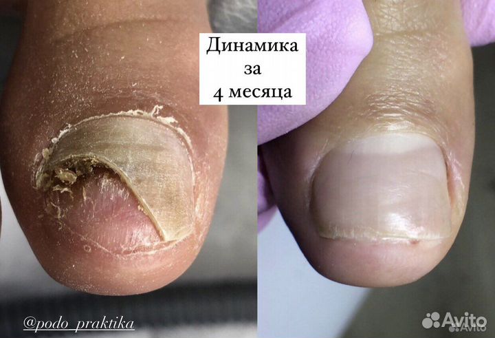 Подолог.Медицинский педикюр.Титановая нить