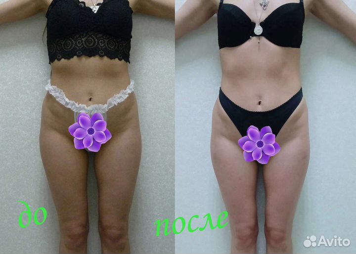 Модель на антицеллюлитный массаж