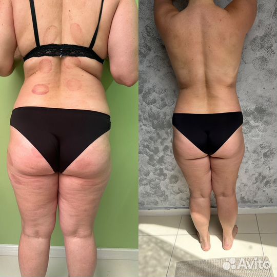 Аппаратный вакуумный массаж вибромассаж