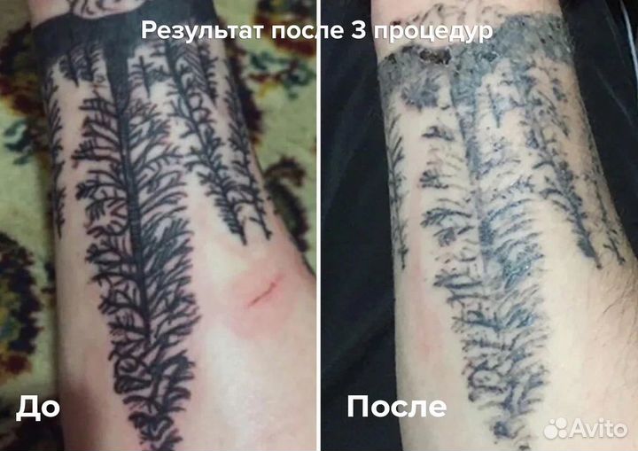 Удаление тутуировок и татуажа