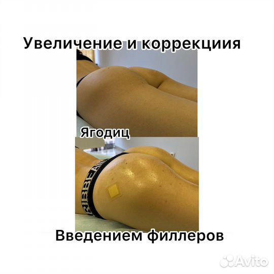 Увеличение ягодиц