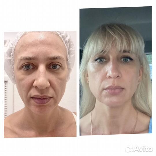 Смас-лифтинг